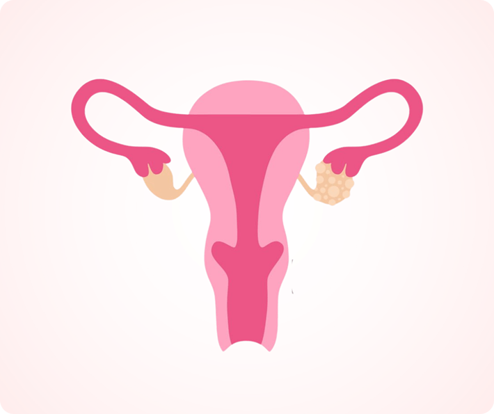 pcos treatment in Dubai