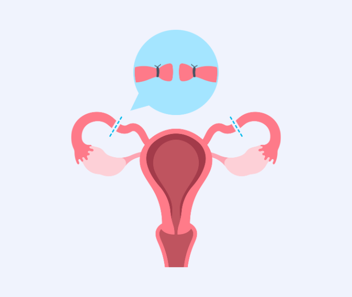 tubal ligation in Dubai