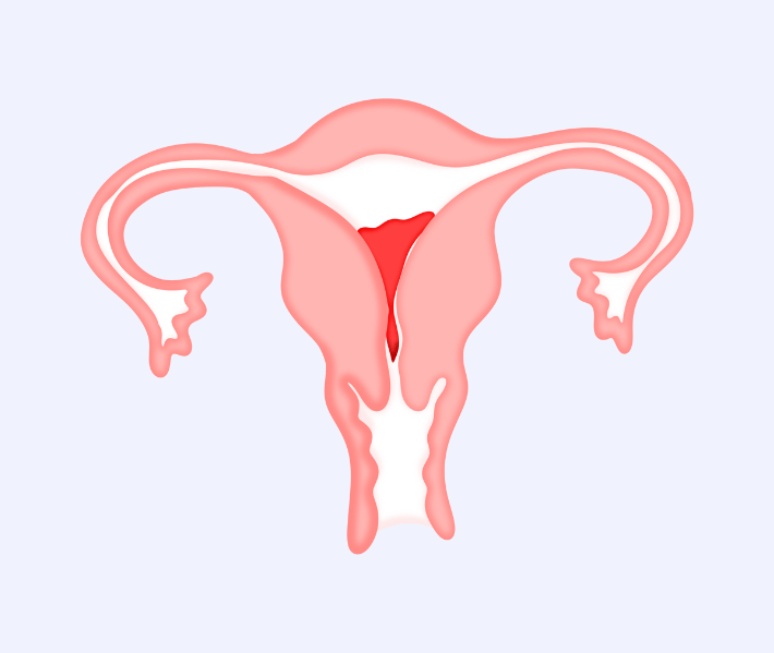 vaginismus treatment Dubai