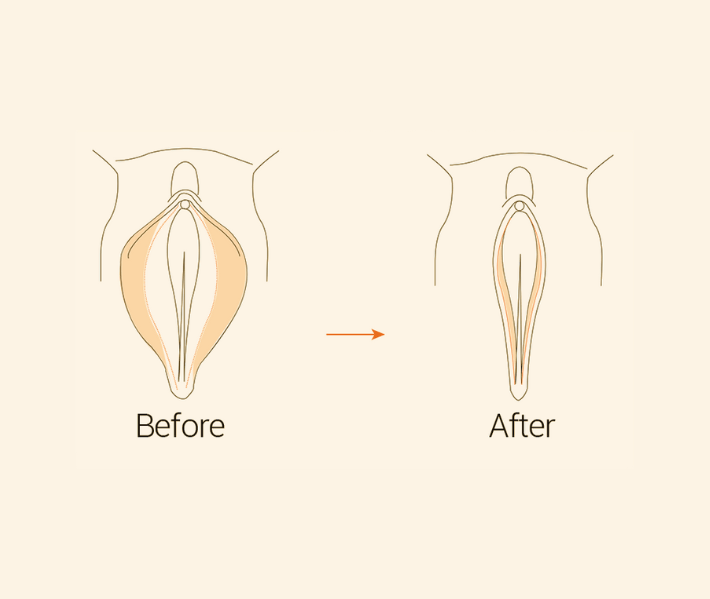 Vaginoplasty Dubai